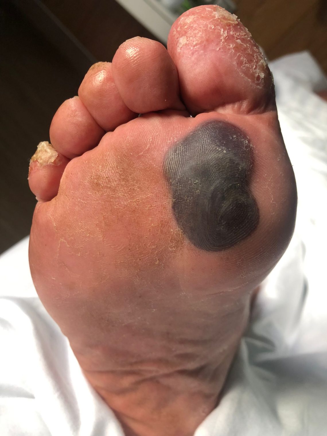 hurt foot